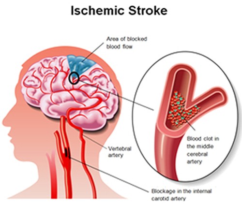 ischemic stroke